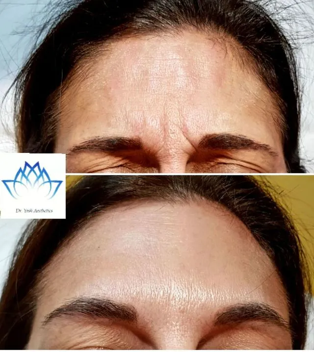 Before and after aesthetic treatment result 1 Dr Yash Aesthetics Colchester