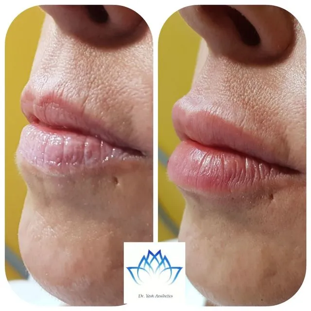 Before and after aesthetic treatment result 2 Dr Yash Aesthetics Colchester