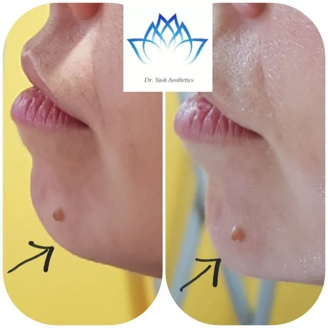 Before and after aesthetic treatment result 3 Dr Yash Aesthetics Colchester