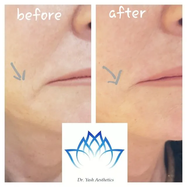 Before and after aesthetic treatment result 7 Dr Yash Aesthetics Colchester