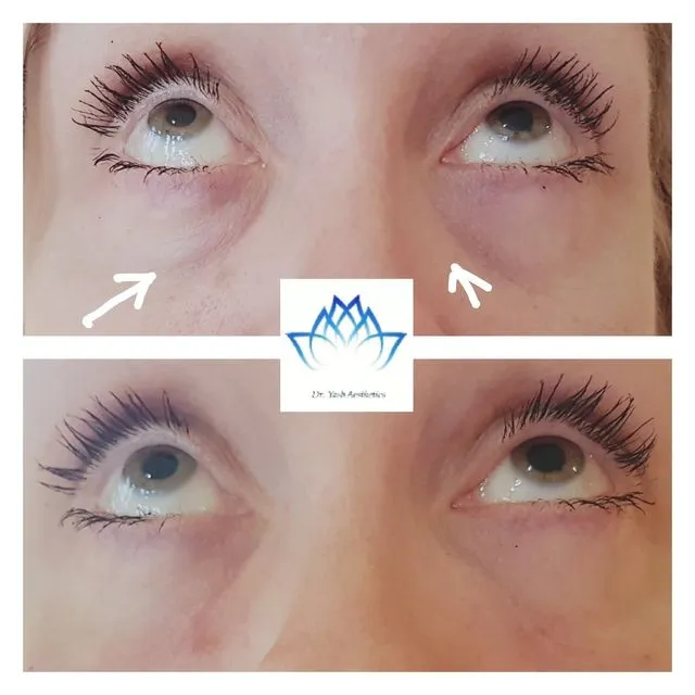 Before and after aesthetic treatment result 9 Dr Yash Aesthetics Colchester