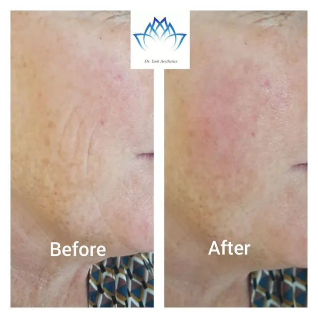 Before and after aesthetic treatment result 13 Dr Yash Aesthetics Colchester